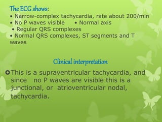 The ECG shows:
• Narrow-complex tachycardia, rate about 200/min
• No P waves visible • Normal axis
• Regular QRS complexes
• Normal QRS complexes, ST segments and T
waves
Clinical interpretation
This is a supraventricular tachycardia, and
since no P waves are visible this is a
junctional, or atrioventricular nodal,
tachycardia.
 