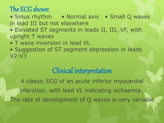 The ECG shows:
• Sinus rhythm • Normal axis • Small Q waves
in lead III but not elsewhere
• Elevated ST segments in leads II, III, VF, with
upright T waves
• T wave inversion in lead VL
• Suggestion of ST segment depression in leads
V2-V3
Clinical interpretation
A classic ECG of an acute inferior myocardial
infarction, with lead VL indicating ischaemia.
The rate of development of Q waves is very variable
 