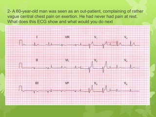 2- A 60-year-old man was seen as an out-patient, complaining of rather
vague central chest pain on exertion. He had never had pain at rest.
What does this ECG show and what would you do next
 
