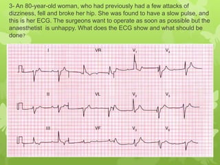 3- An 80-year-old woman, who had previously had a few attacks of
dizziness, fell and broke her hip. She was found to have a slow pulse, and
this is her ECG. The surgeons want to operate as soon as possible but the
anaesthetist is unhappy. What does the ECG show and what should be
done?
 