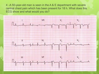 4 -A 50-year-old man is seen in the A & E department with severe
central chest pain which has been present for 18 h. What does this
ECG show and what would you do?
 