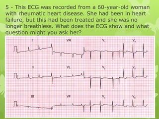 5 - This ECG was recorded from a 60-year-old woman
with rheumatic heart disease. She had been in heart
failure, but this had been treated and she was no
longer breathless. What does the ECG show and what
question might you ask her?
 
