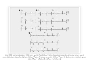 LD ECG Talk March 2016