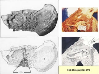 ECG Clínica de los CVD
 