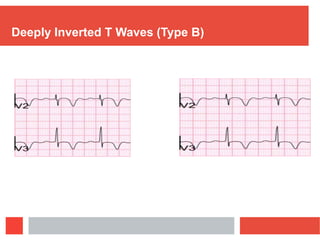 Ecg challenges | PPTX