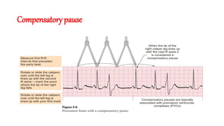 ECG changes, changes in intraventricular conduction | PPTX