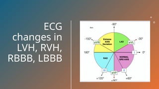 Electrocardiogram (ECG) Changes in LVH, RVH, RBBB, and LBBB Explained ...