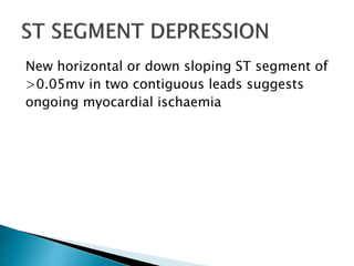 New horizontal or down sloping ST segment of
>0.05mv in two contiguous leads suggests
ongoing myocardial ischaemia
 