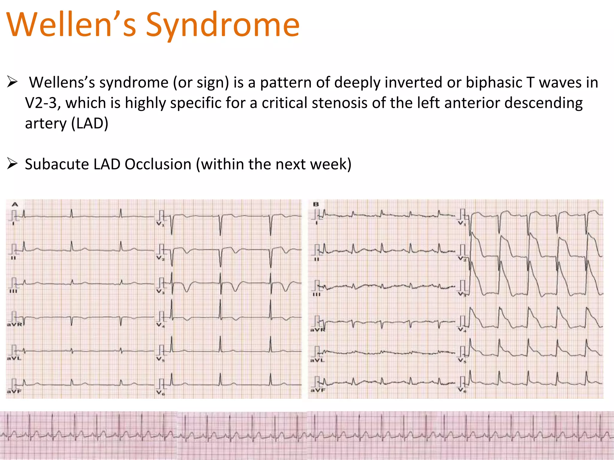 ECG Changes in Myocardial ischemia, myocardial infarction.pptx