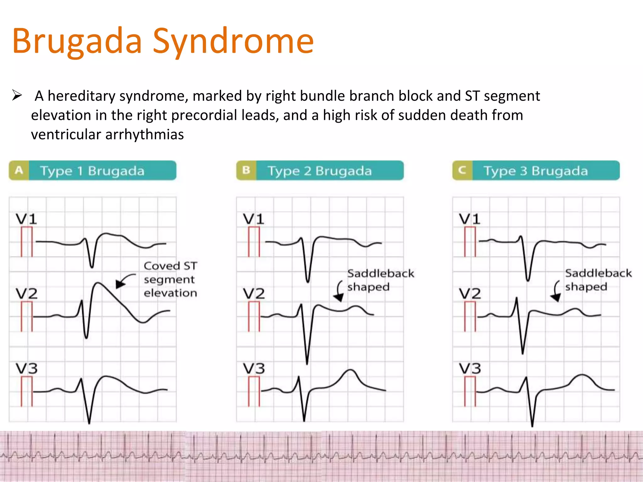 ECG Changes in Myocardial ischemia, myocardial infarction.pptx