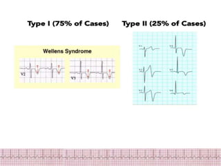 ECG Changes in Myocardial ischemia, myocardial infarction.pptx