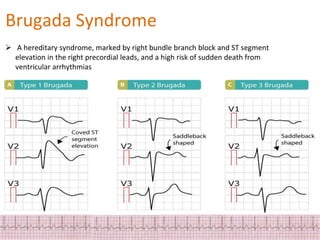 ECG Changes in Myocardial ischemia, myocardial infarction.pptx