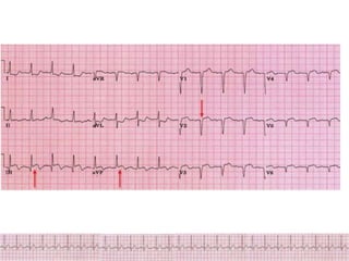 ECG Changes in Myocardial ischemia, myocardial infarction.pptx