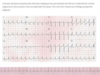 ECG Changes in Myocardial ischemia, myocardial infarction.pptx