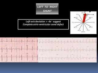 LEFT TO RIGHT
SHUNT
Left axis deviation > -60᷁ suggest
Complete atrio-ventricular canal defect
 