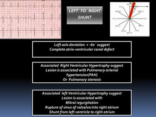 LEFT TO RIGHT
SHUNT
Left axis deviation > -60᷁ suggest
Complete atrio-ventricular canal defect
Associated RightVentricular Hypertrophy suggest
Lesion is associated with Pulmonary arterial
hypertension(PAH)
Or Pulmonary stenosis
Associated leftVentricular Hypertrophy suggest
Lesion is associated with
Mitral regurgitation
Rupture of sinus of valsalva into right atrium
Shunt from left ventricle to right atrium
 