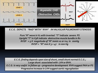 E.C.G. DEPICTS “RAD”WITH “ RVH” IN VALVULAR PULMONARY STENOSIS
Pure “R” wave inV1 with inverted “T” indicate severe PS
Upright “T” inV3R indicate obstructive muscle bundle in Rv
RVSP = 5 X magnitude of “R” mmin v1 or rv4 in mmHg
RVSP = “R” mm X 3 + 47 in mm Hg
E.C.G. finding depends upon size of shunt, small shunt normal E.C.G.;
Large shunt associated with LVH or BVH.
E.C.G. is very useful in follow up – progressive development RVH suggest PAH or PS
Progressive increase in LVH suggest aortic regurgitation
Acyanotic CHD
Obstructive CHDs
 