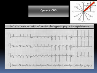 Left axis deviation with left ventricular hypertrophy - tricuspid atresia
Cyanotic CHD
 