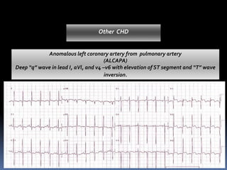 Ebstein ‘s anomaly :Tall “Himalayan” P waves, prolonged RR intervale & QRS – RBBB
Type “B”WPW syndrome (right side kent bundle)
PSVT, Atrial flutter or fibrilation (1/3)
Anomalous left coronary artery from pulmonary artery
(ALCAPA)
Deep “q” wave in lead I, aVl, and v4 –v6 with elevation of ST segment and “T” wave
inversion.
Pompes’ disease – Short PR intervale LAD with LVH (huge QRS)
Other CHD
Corrected -T.G.A. - Absent “q” wave in lead I & aVL and present in right sided leads
III & aVF. Positive “T” wave in all chest leads
Prolonged PR interval; PVST;Type AWPW syndrome
 
