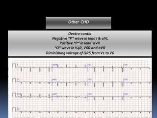 Dextro-cardia
Negative “P” wave in lead I & aVL
Positive “P” in lead aVR
“Q” wave inV4R,V6R and aVR
Diminishing voltage of QRS from V1 toV6
Other CHD
 
