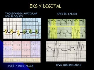 EKG Y DIGITAL
TAQUICARDIA AURICULAR      CPVS EN SALVAS
CON BLOQUEO




 CUBETA DIGITALICA        CPVS BIGEMINADAS
 