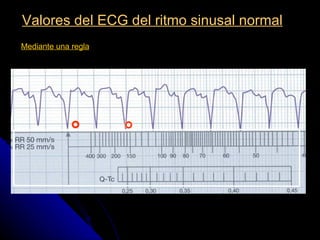 Valores del ECG del ritmo sinusal normal
                         Cálculo de la frecuencia cardiaca (3)
4.- Mediante una regla
 
