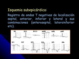 Isquemia subepicárdica:
Registro de ondas T negativas de localización
septal, anterior, inferior y lateral y sus
combinaciones (anteroseptal, lateroinferior
etc).
 