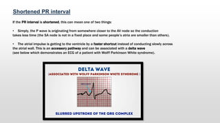 Shortened PR interval
If the PR interval is shortened, this can mean one of two things:
• Simply, the P wave is originating from somewhere closer to the AV node so the conduction
takes less time (the SA node is not in a fixed place and some people’s atria are smaller than others).
• The atrial impulse is getting to the ventricle by a faster shortcut instead of conducting slowly across
the atrial wall. This is an accessory pathway and can be associated with a delta wave
(see below which demonstrates an ECG of a patient with Wolff Parkinson White syndrome).
 