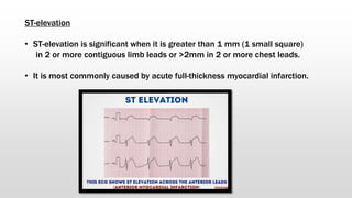 ST-elevation
• ST-elevation is significant when it is greater than 1 mm (1 small square)
in 2 or more contiguous limb leads or >2mm in 2 or more chest leads.
• It is most commonly caused by acute full-thickness myocardial infarction.
 