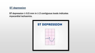ST depression
ST depression ≥ 0.5 mm in ≥ 2 contiguous leads indicates
myocardial ischaemia.
 