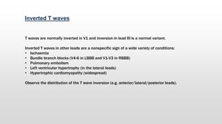 Inverted T waves
T waves are normally inverted in V1 and inversion in lead III is a normal variant.
Inverted T waves in other leads are a nonspecific sign of a wide variety of conditions:
• Ischaemia
• Bundle branch blocks (V4-6 in LBBB and V1-V3 in RBBB)
• Pulmonary embolism
• Left ventricular hypertrophy (in the lateral leads)
• Hypertrophic cardiomyopathy (widespread)
Observe the distribution of the T wave inversion (e.g. anterior/lateral/posterior leads).
 