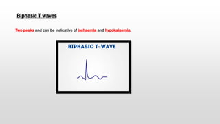 Biphasic T waves
Two peaks and can be indicative of ischaemia and hypokalaemia.
 