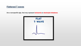 Flattened T waves
Are a non-specific sign, that may represent ischaemia or electrolyte imbalance.
 