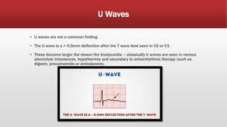 U Waves
▪ U waves are not a common finding.
▪ The U wave is a > 0.5mm deflection after the T wave best seen in V2 or V3.
▪ These become larger the slower the bradycardia – classically U waves are seen in various
electrolyte imbalances, hypothermia and secondary to antiarrhythmic therapy (such as
digoxin, procainamide or amiodarone).
 