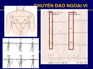 16
CHUYỂN ĐẠO NGOẠI VI
• Khảo sát tim theo mặt phẳng trán
 