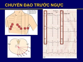 17
CHUYỂN ĐẠO TRƢỚC ỰC
 