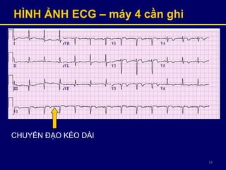 19
HÌNH ẢNH ECG – máy 4 cần ghi
CHUYỂN ĐẠO KÉO DÀI
 