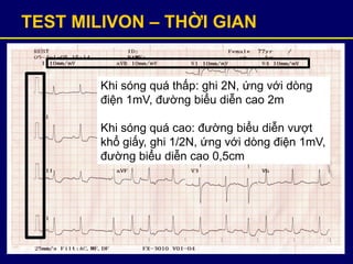 TEST MILIVON – THỜI GIAN
Khi sóng quá thấp: ghi 2N, ứng với dòng
điện 1mV, đường biểu diễn cao 2m
Khi sóng quá cao: đường biểu diễn vượt
khổ giấy, ghi 1/2N, ứng với dòng điện 1mV,
đường biểu diễn cao 0,5cm
 