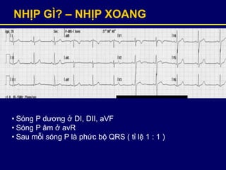 NHỊP GÌ? – NHỊP XOANG
• Sóng P dương ở DI, DII, aVF
• Sóng P âm ở avR
• Sau mỗi sóng P là phức bộ QRS ( tỉ lệ 1 : 1 )
 