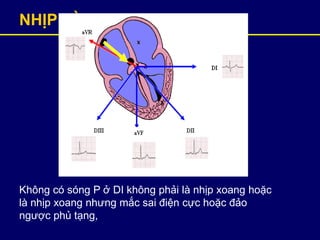 NHỊP GÌ? – NHỊP XOANG
Không có sóng P ở DI không phải là nhịp xoang hoặc
là nhịp xoang nhưng mắc sai điện cực hoặc đảo
ngược phủ tạng,
 