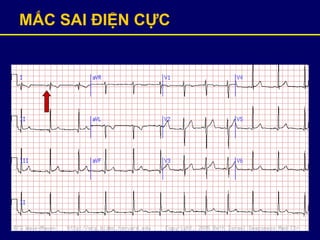 MẮC SAI ĐIỆN ỰC
 