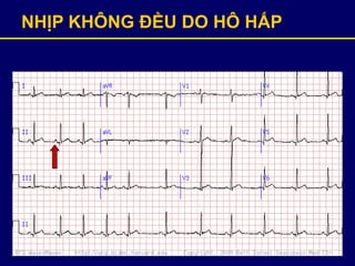 NHỊP KHÔNG ĐỀU DO HÔ HẤP
 