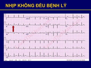NHỊP KHÔNG ĐỀU BỆNH LÝ
 