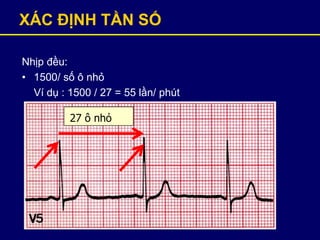 XÁC ĐỊNH TẦN SỐ
Nhịp đều:
• 1500/ số ô nhỏ
Ví dụ : 1500 / 27 = 55 lần/ phút
27 ô nhỏ
 
