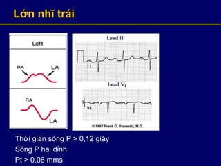 Lớn nhĩ trái
Thời gian sóng P > 0,12 giây
Sóng P hai đỉnh
Pt > 0.06 mms
 