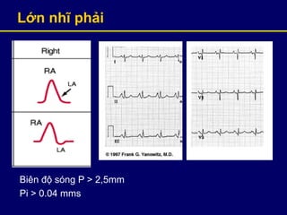 Lớn nhĩ phải
Biên độ sóng P > 2,5mm
Pi > 0.04 mms
 