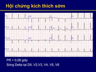 Hội chứng kích thích sớm
PR = 0,08 giây
Sóng Delta tại DII, V2,V3, V4, V5, V6
 
