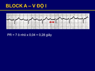 BLOCK A – V ĐỘ I
PR = 7 ô nhỏ x 0,04 = 0,28 giây
 