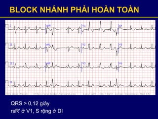 BLOCK NHÁNH PHẢI HOÀN TOÀN
QRS > 0,12 giây
rsR’ ở V1, S rộng ở DI
 
