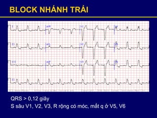 BLOCK NHÁNH TRÁI
QRS > 0,12 giây
S sâu V1, V2, V3, R rộng có móc, mất q ở V5, V6
 